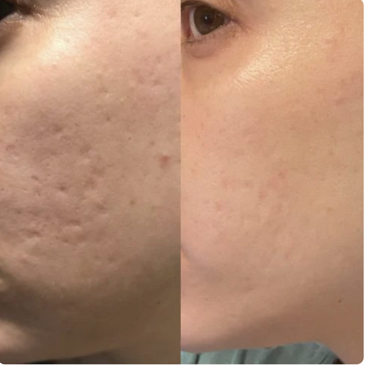 Eliminador de cicatrices