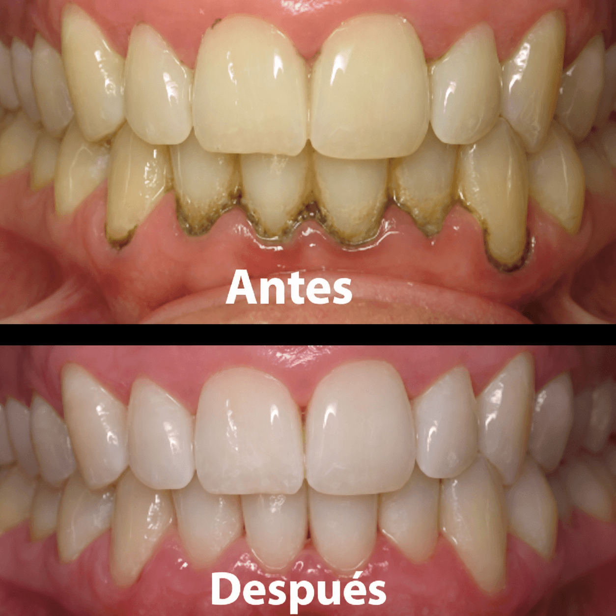 Gel para reparar encias