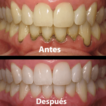 Gel para reparar encias